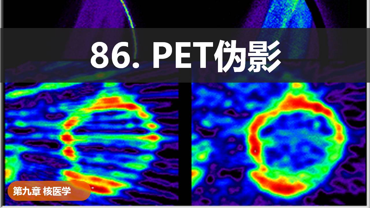 86.PET伪影