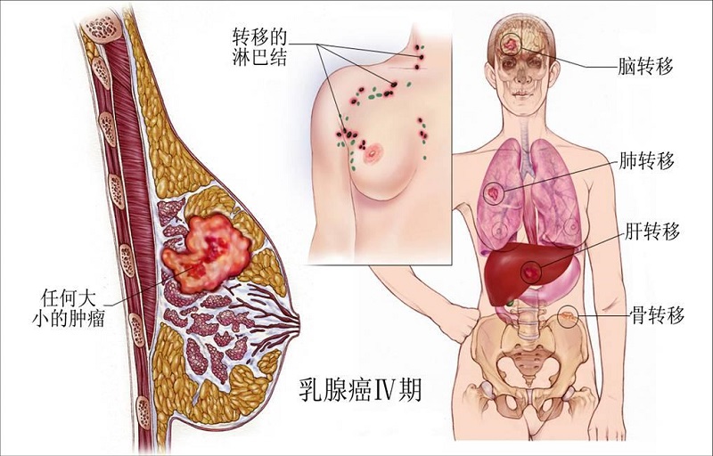 女性头号杀手----乳腺癌