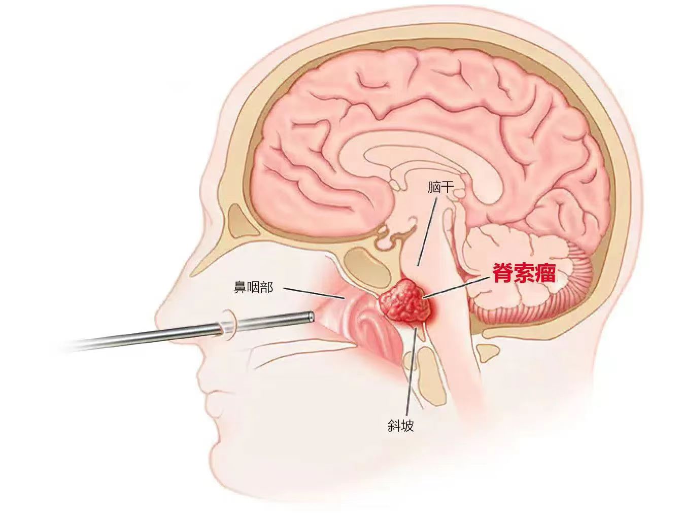 颈静脉孔区的脊索瘤