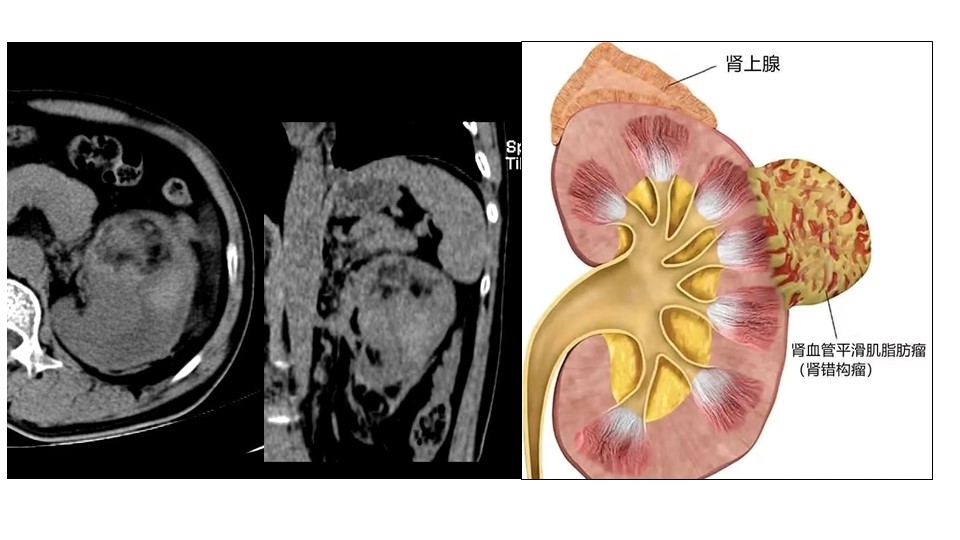 肾血管平滑肌脂肪瘤并出血