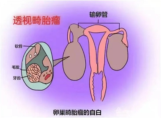 躲在肚子里的“妖怪”---畸胎瘤