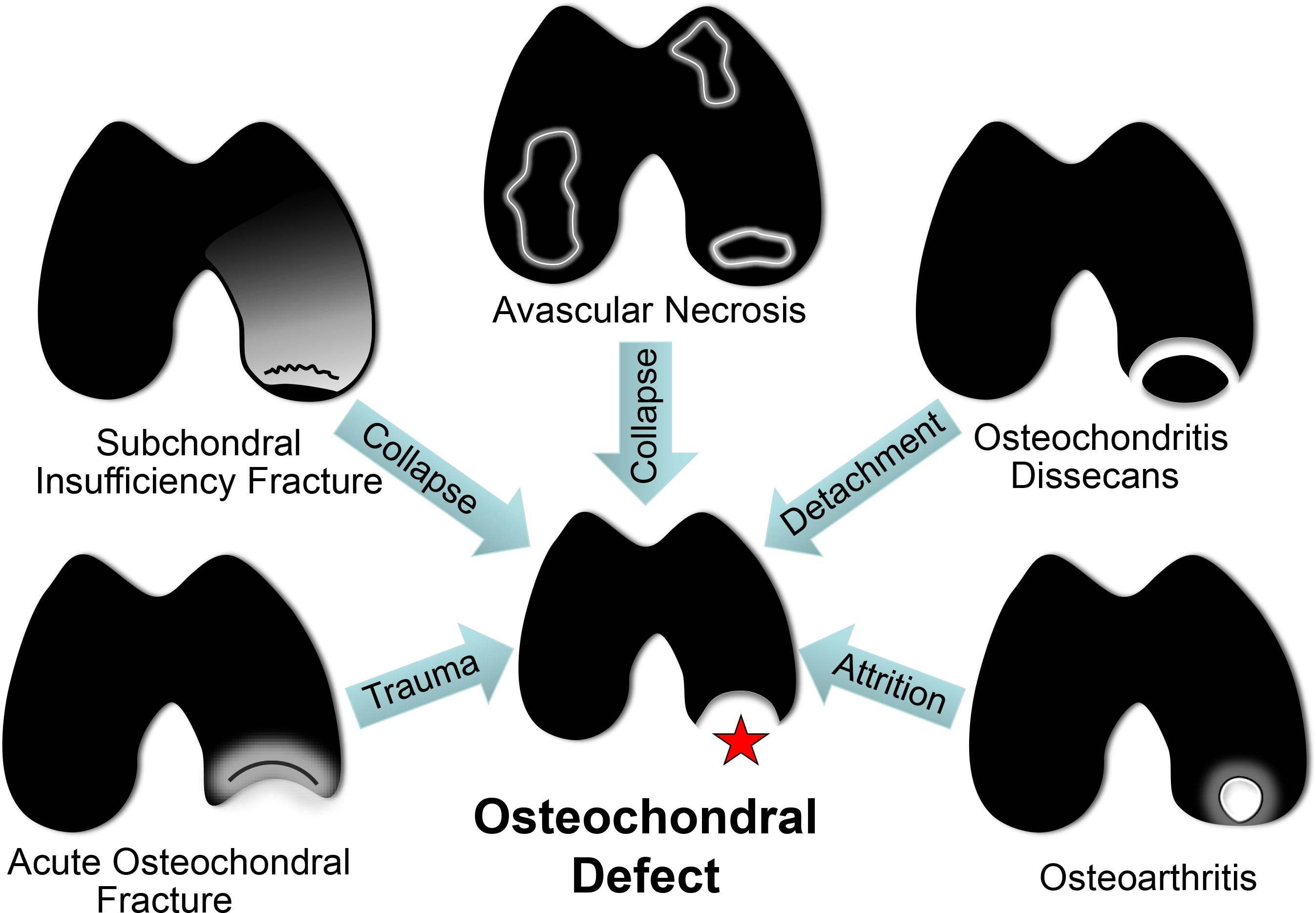 软骨下机能不全骨折（Subchondral insufficiency fracture，SIF）