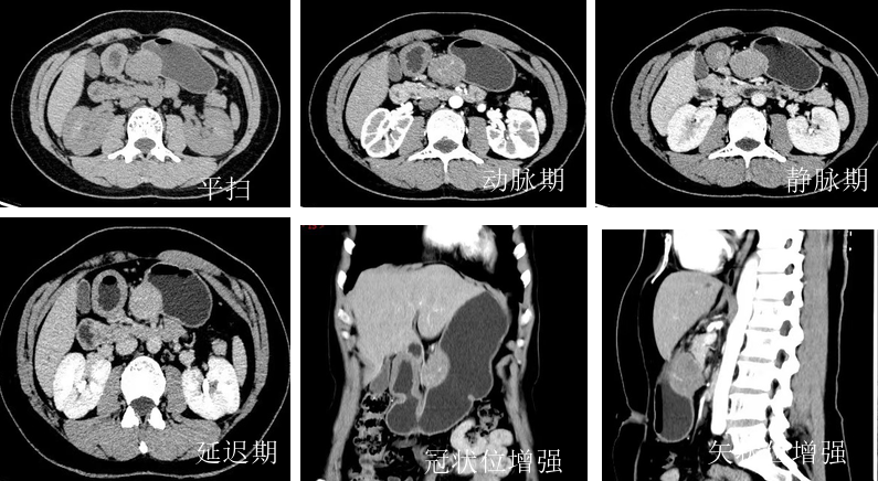 胃神经鞘瘤