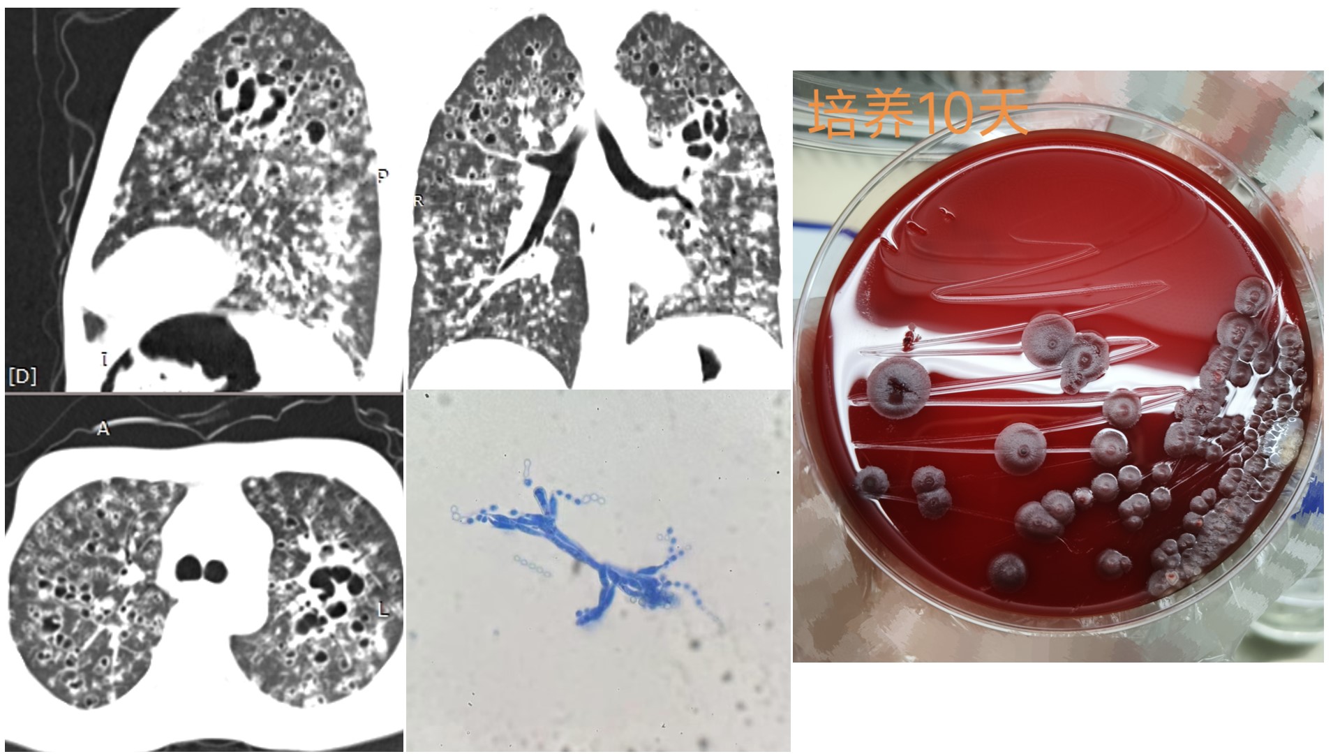 HIV合并不典型马尔尼菲篮状菌感染