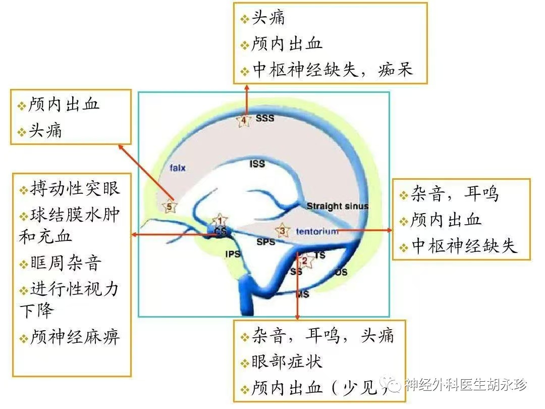 儿童硬脑膜动静脉瘘