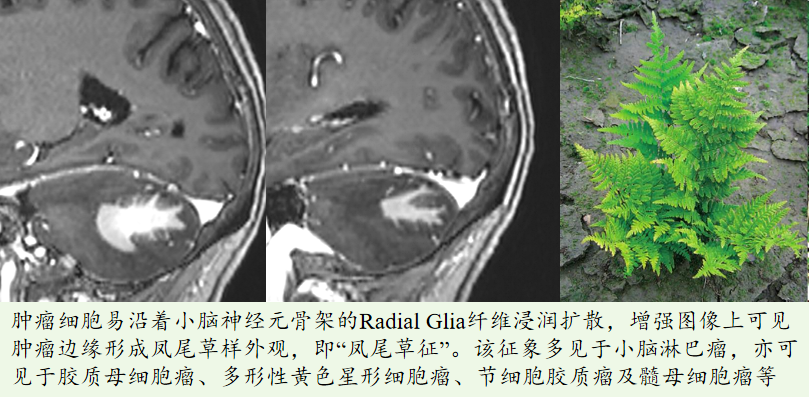 当小脑开出“凤尾草”：淋巴瘤的影像警示征