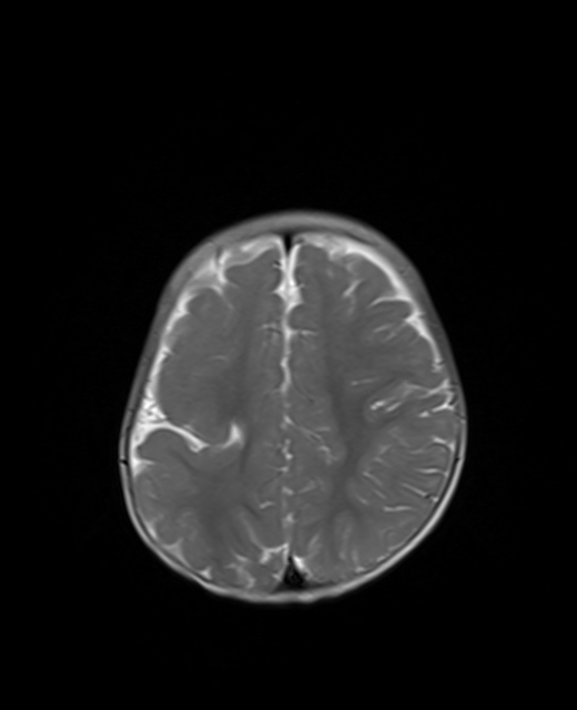 脑裂畸形Ⅱ型