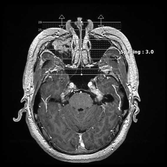 上颌窦内翻性乳头状瘤