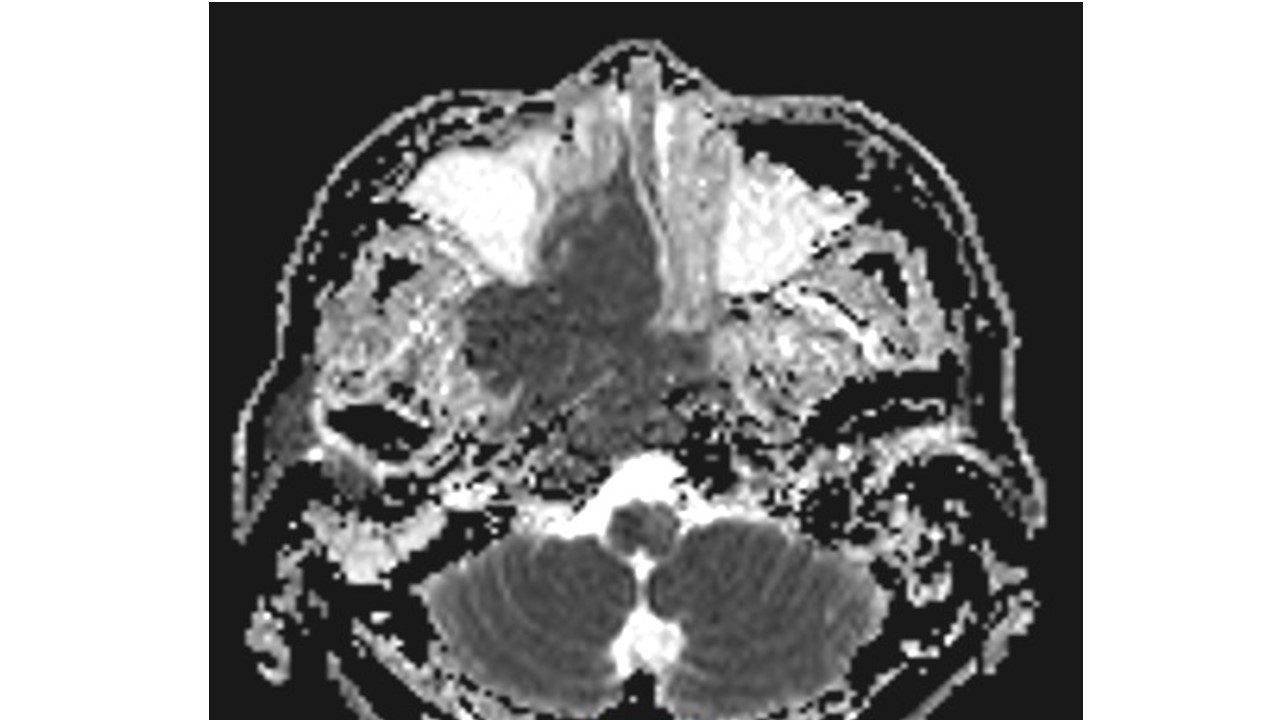 鼻咽部非角化癌-中国医学影像联盟-China Medical Imaging Association