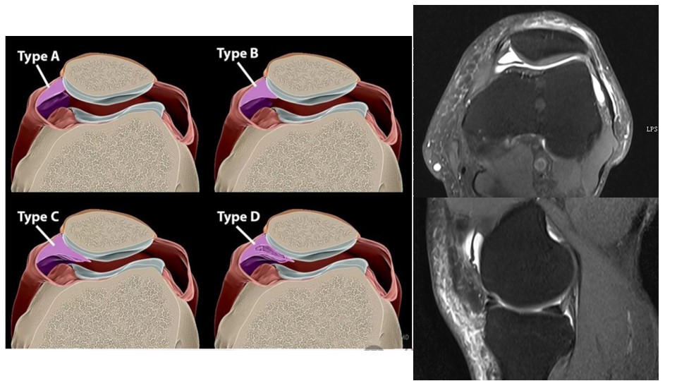 髌内侧滑膜皱襞综合征-中国医学影像联盟-China Medical Imaging Association