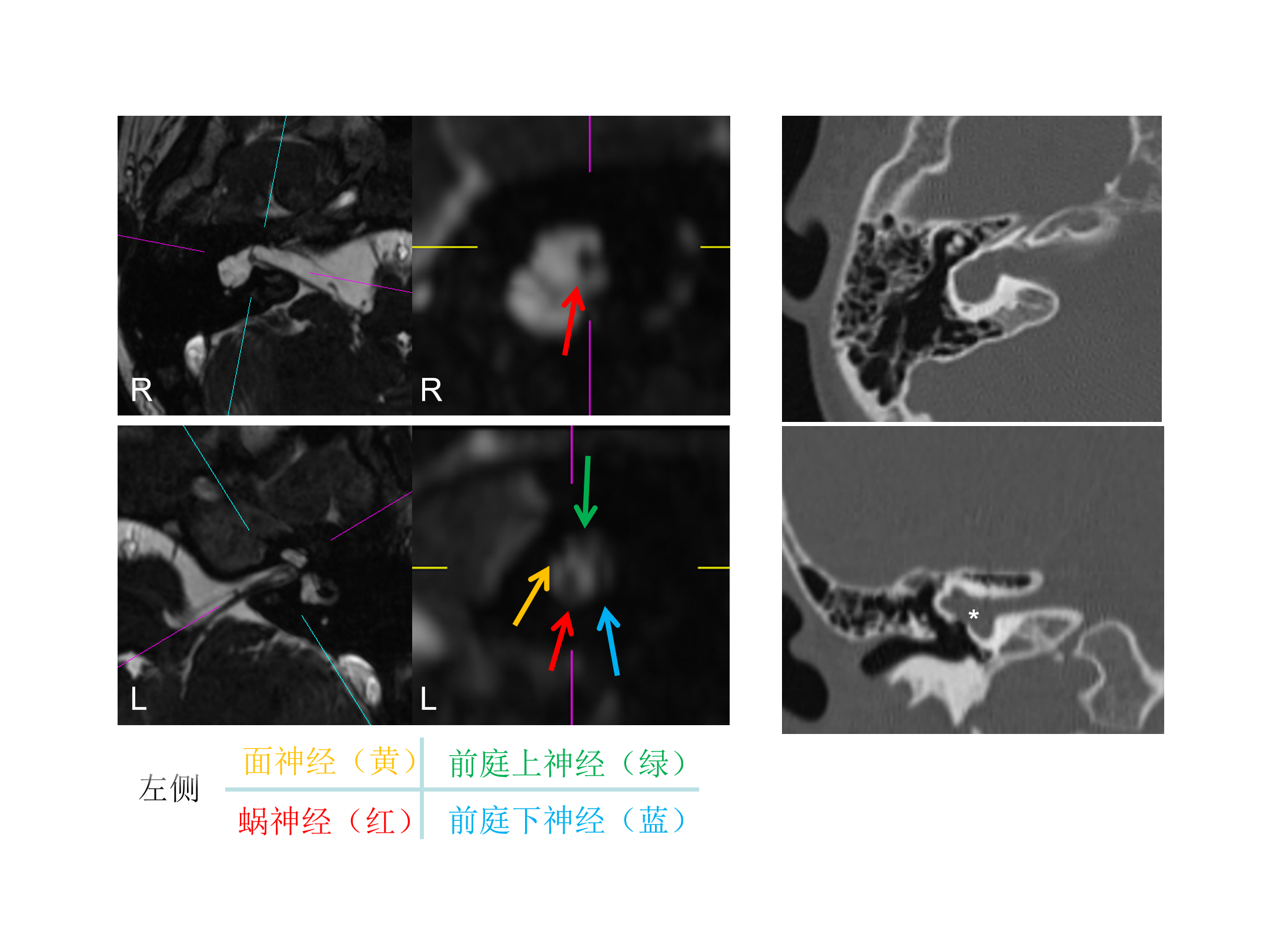 “前庭耳蜗串通一气”——共同腔畸形-中国医学影像联盟-China Medical Imaging Association