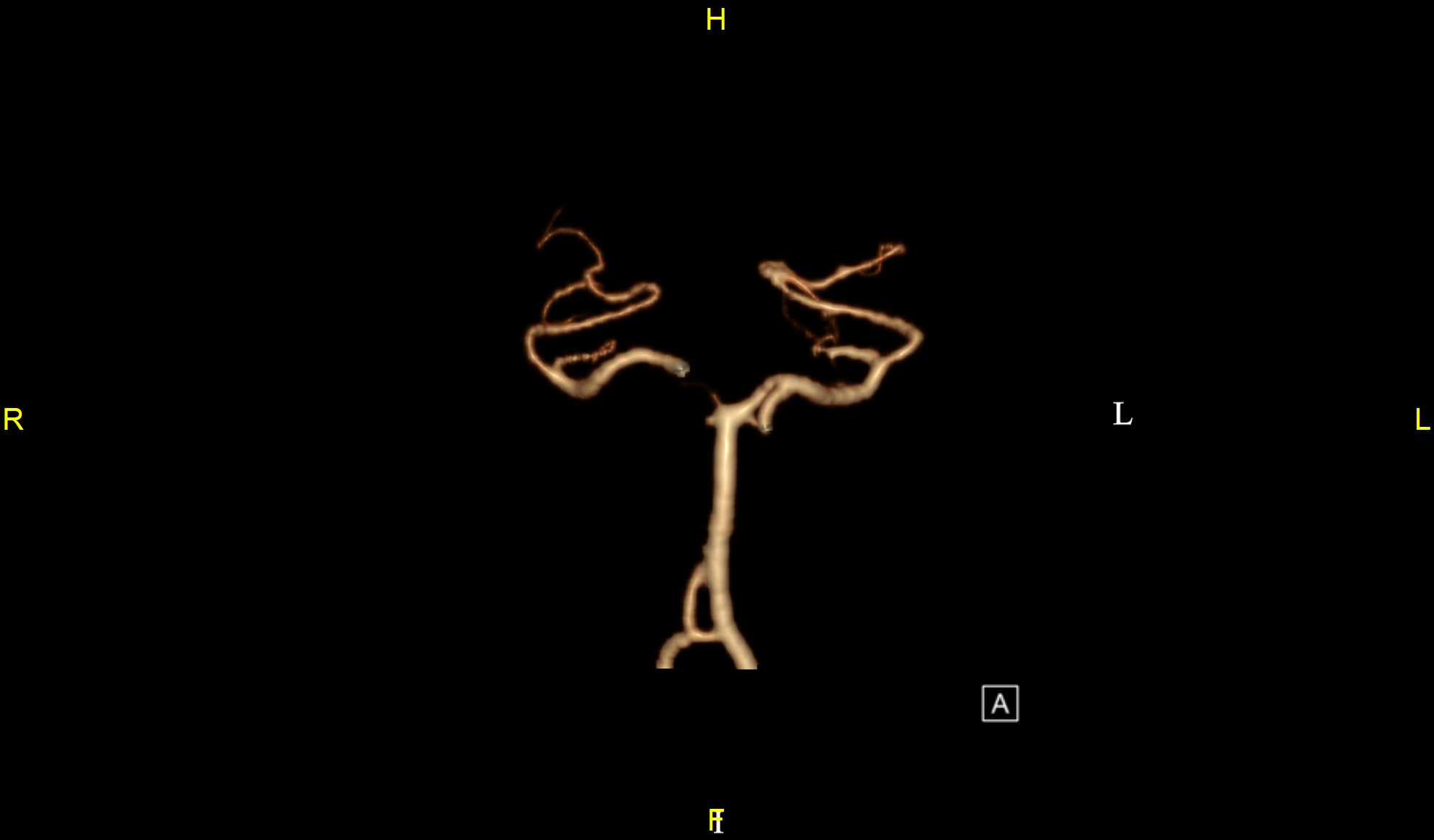 椎基底动脉开窗畸形-中国医学影像联盟-china medical imaging
