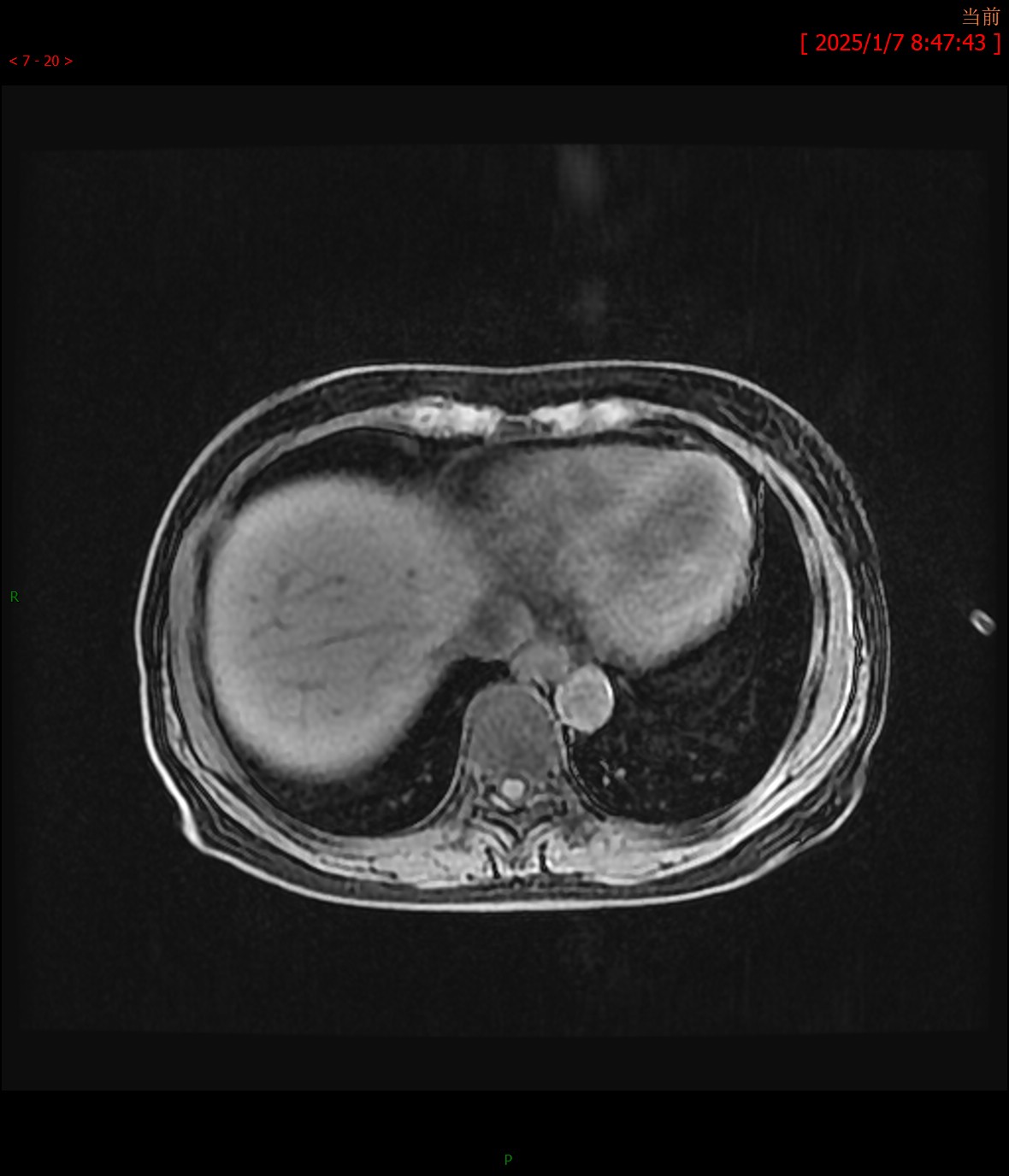 胰腺实性假乳头状瘤
